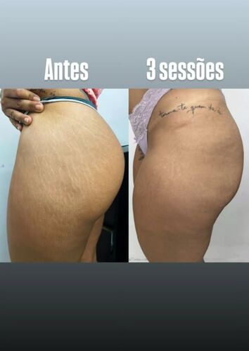 Antes e depois